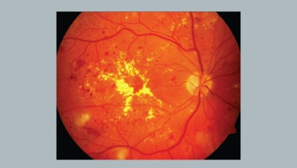 Intense diabetes treatment prevents damage to vision