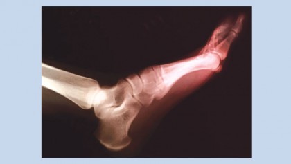 Certain diabetes 
medicines may 
lower gout risk