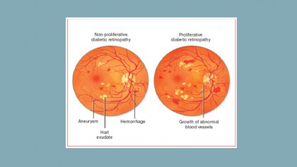 A patient presenting with diabetic retinopathy