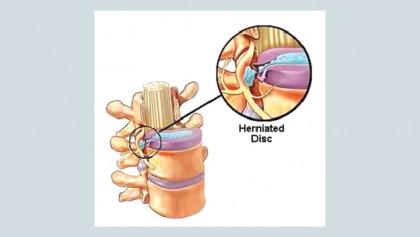 Lumbar disc prolapse: understanding and ways of prevention