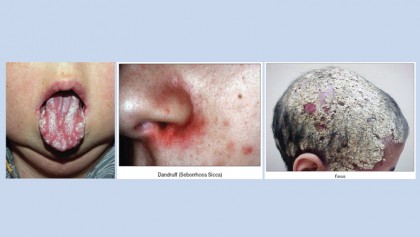 Diseases due to fungi