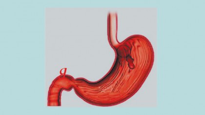 Upper gastrointestinal bleeding