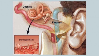 Noise-induced hearing loss