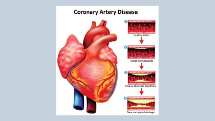 Attempts aiming at prevention of coronary heart diseases