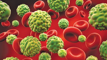 Signs and symptoms of leukemia