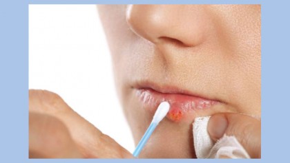 How to treat and prevent cold sores on your lips