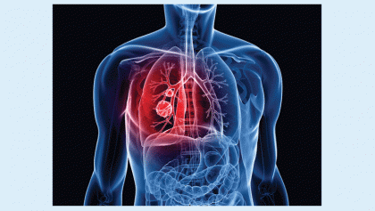 Emerging role of immunotherapy of lung cancer