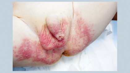 Skin diseases in neonates