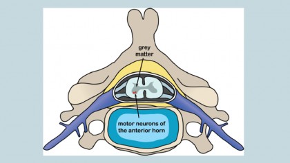 Meningitis and occupational therapy