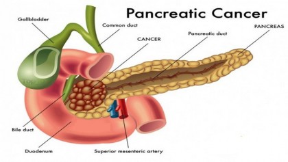 2-drug regimen shows promise against pancreatic cancer