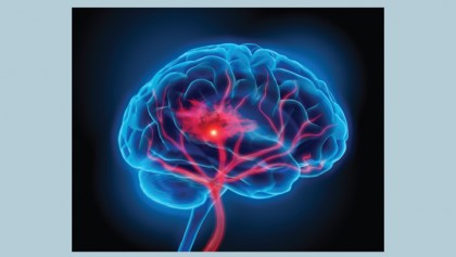 What’s your reason for 
preventing stroke?