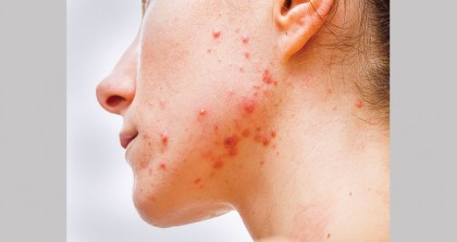 FDA okays non-prescription 
use of acne drug
