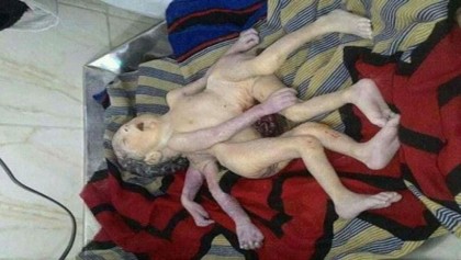Conjoined Bhutanese twins separated in Australia surgery