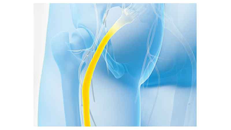 11 Highly effective solutions for sciatic nerve pain