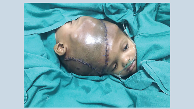 Indian doctors separate twins joined at head