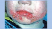 FAQ on streptococcal infections