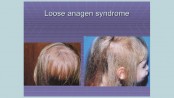 Hair disorders in children