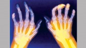 Rheumatoid arthritis facts