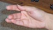 Hypocalcaemia