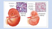 Kidney failure