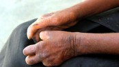 Leprosy issue deserves due attention     