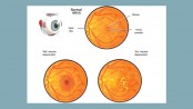 Macular degeneration 