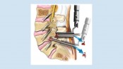 Microscopic lumbar discectomy