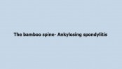 The bamboo spine- Ankylosing spondylitis