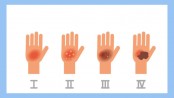 Burns: Types, treatments, and prevention