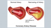 All about coronary artery disease