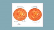 A patient presenting with diabetic retinopathy