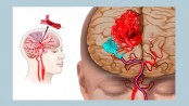 Brain attack: tips to lower the risk 