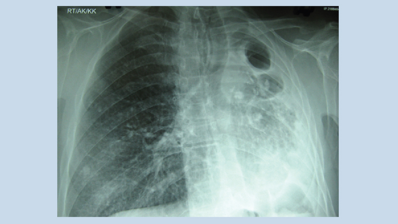 How to prevent a tubercular infection?