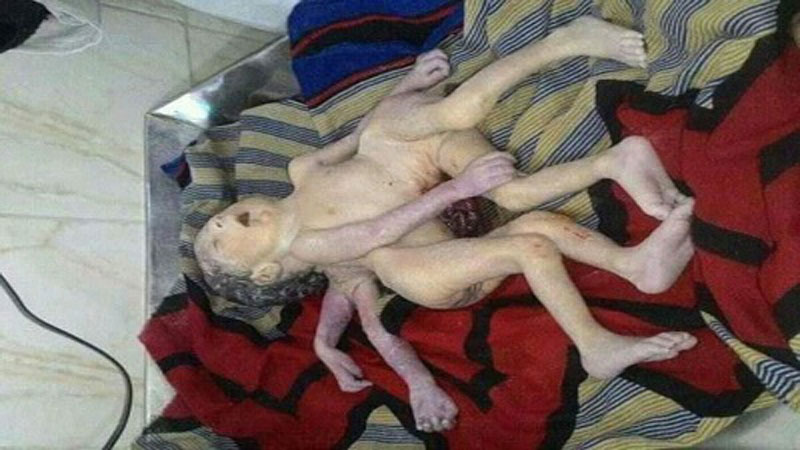 Conjoined Bhutanese twins separated in Australia surgery