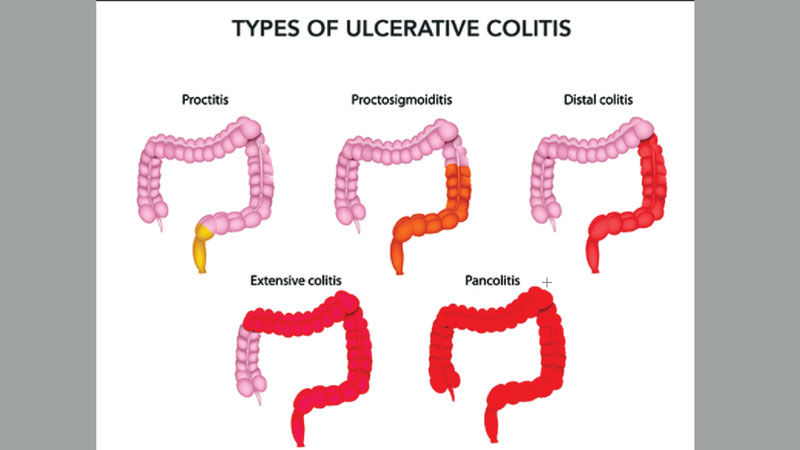 Facts about 
ulcerative colitis 